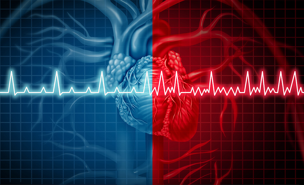 Illustration of heart with atrial fibrillation next to heart without atrial fibrillation.